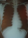Mylung