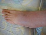 110724 Cellulitis of Lt Foot02