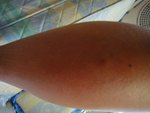 110724 Cellulitis of Lt Foot04