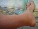110724 Cellulitis of Lt Foot05