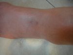 110724 Cellulitis of Lt Foot09