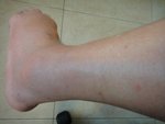 110724 Cellulitis of Lt Foot10