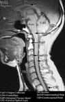 MRI - Head & Neck (Sagittal)