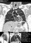 MRI - Chest (Coronal)