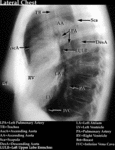 XR - Abnormal Chest (Lateral)