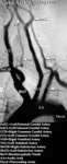 XR Contrast - Aortic Arch Angiogram