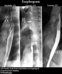 XR Contrast - Esophogram