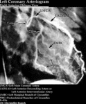 XR Contrast - Left Coronory Arteriogram (RAO)