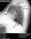 XR - Normal Chest (Lateral)