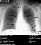 XR - Normal Chest (PA)