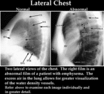 XR - Normal vs Abnormal Lateral Chest