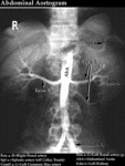 XR Contrast - Abdominal Aortogram