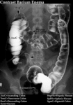 XR Contrast - Barium Enema