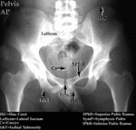XR - Pelvis (AP) #1