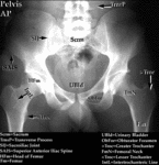 XR - Pelvis (AP) #2