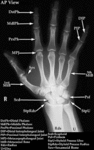 XR - Hand (AP)