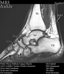 MRI - Ankle (Sagittal)