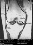 MRI - Knee (Coronal)