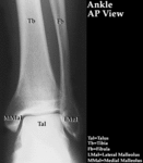 XR - Ankle (AP)