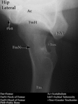 XR - Hip (Lateral)