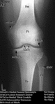 XR - Knee (AP)