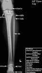 XR - Lower Leg (AP)