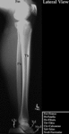 XR - Lower Leg (Lateral)