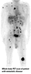 PET scan