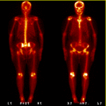 Skeletal scan