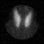 Thyroid scan