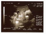 34 Weeks
(3-Nov-05)